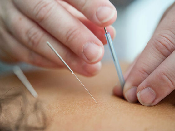 The History of Acupuncture: How Does it Work?