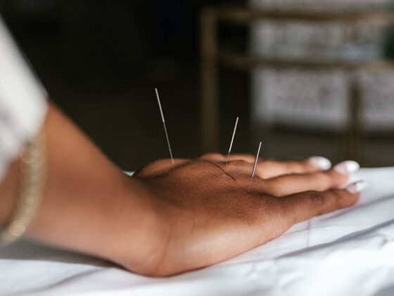 Acupuncture in Somerset, NJ (Best Reviewed)