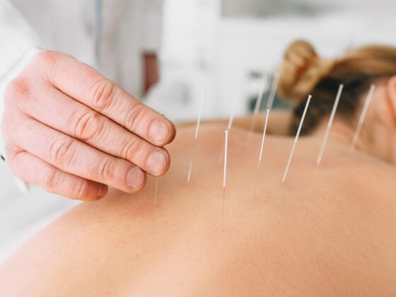 Acupuncture for Sciatica – Relieve Chronic Pain