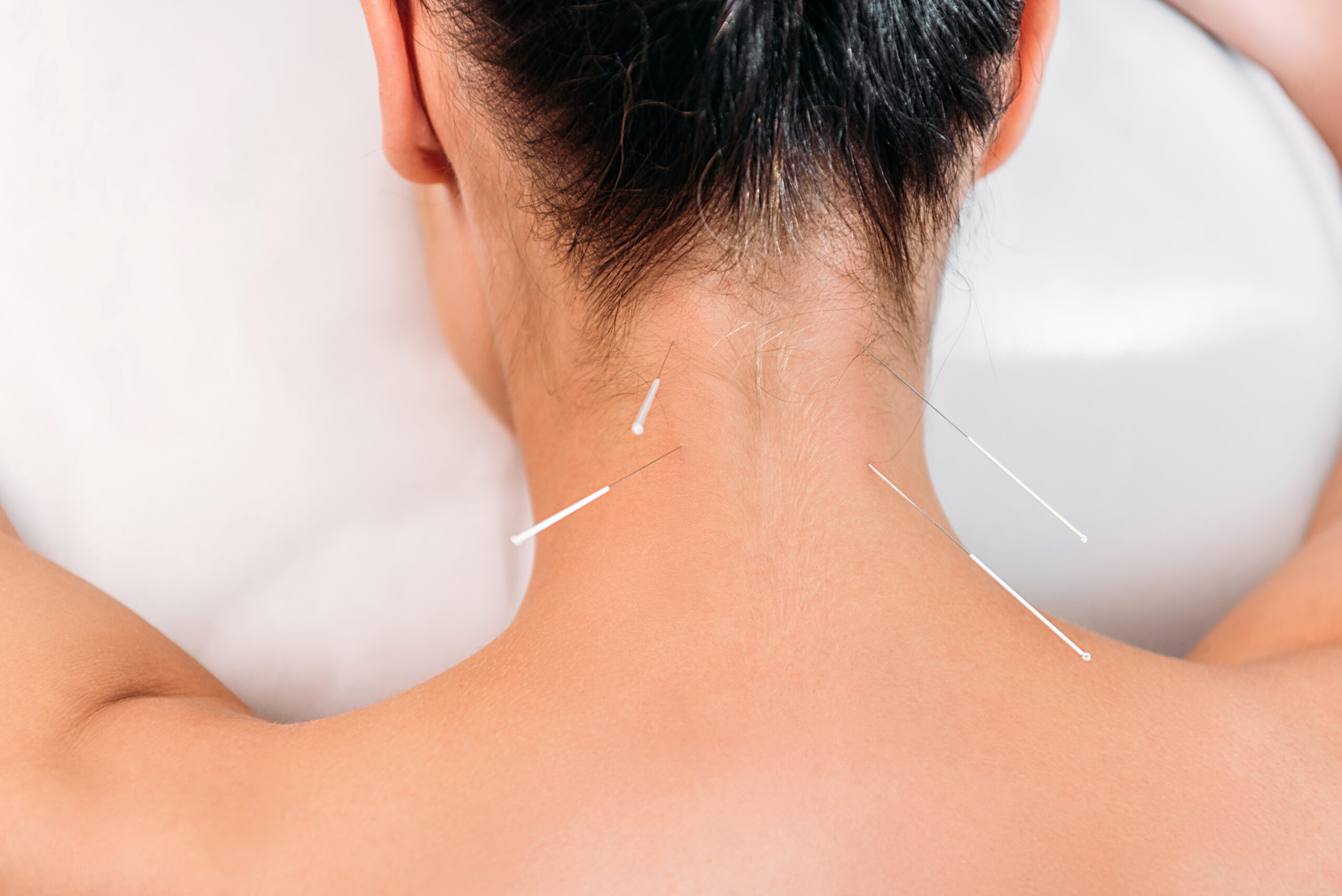 https://elements.envato.com/partial-view-of-woman-having-acupuncture-therapy-i-XZVC4C9